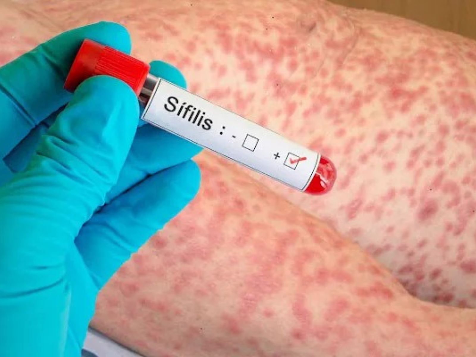 Alerta sanitaria: el Ministerio de Salud destaca la importancia de la detección temprana de la sífilis